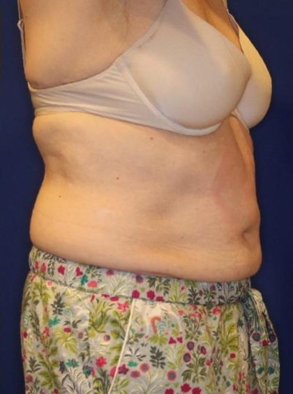 Body Contouring Before & After Patient #14226