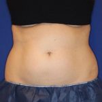 Body Contouring Before & After Patient #14229