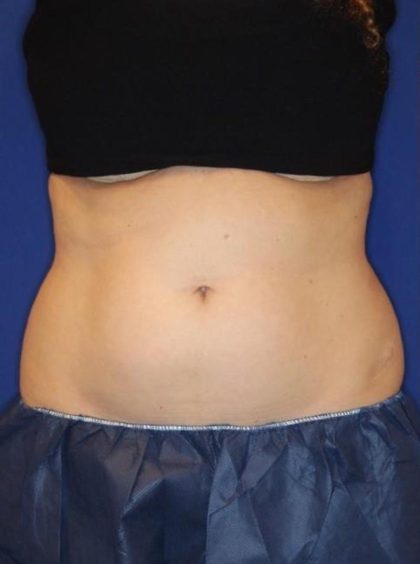Body Contouring Before & After Patient #14229