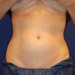 Body Contouring Before & After Patient #14229