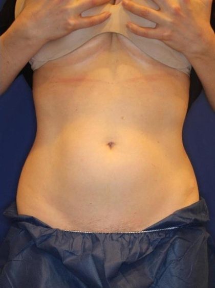 Body Contouring Before & After Patient #14229