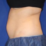 Body Contouring Before & After Patient #14229