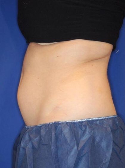 Body Contouring Before & After Patient #14229