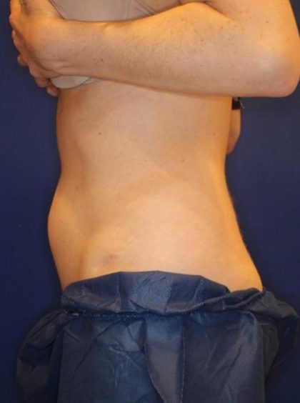 Body Contouring Before & After Patient #14229