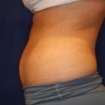 Body Contouring Before & After Patient #14230
