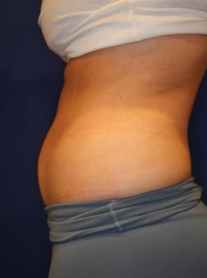 Body Contouring Before & After Patient #14230