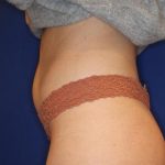 Body Contouring Before & After Patient #14230
