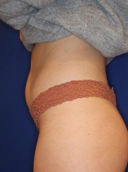 Body Contouring Before & After Patient #14230