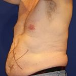 Body Contouring Before & After Patient #14231