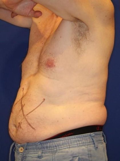Body Contouring Before & After Patient #14231