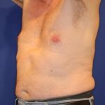 Body Contouring Before & After Patient #14231