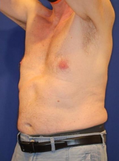 Body Contouring Before & After Patient #14231
