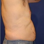 Body Contouring Before & After Patient #14231