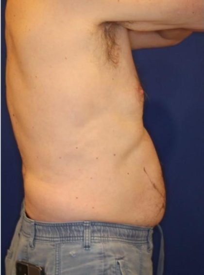 Body Contouring Before & After Patient #14231