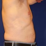 Body Contouring Before & After Patient #14231