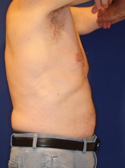 Body Contouring Before & After Patient #14231