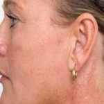 Brown Spot Removal Before & After Patient #14193