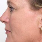 Brown Spot Removal Before & After Patient #14193