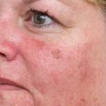 Brown Spot Removal Before & After Patient #14194