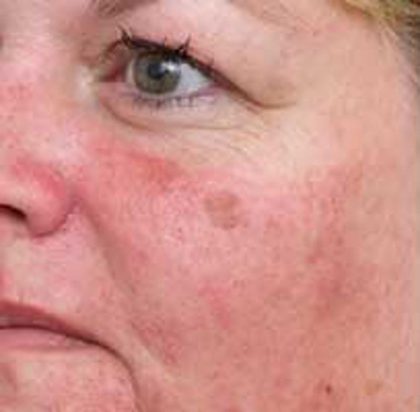 Brown Spot Removal Before & After Patient #14194