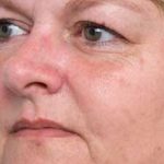 Brown Spot Removal Before & After Patient #14194