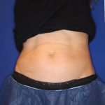 Emsculpt NEO Before & After Patient #14257