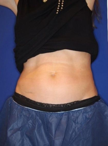 Emsculpt NEO Before & After Patient #14257