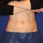 Emsculpt NEO Before & After Patient #14257