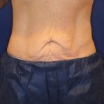 Emsculpt NEO Before & After Patient #14258