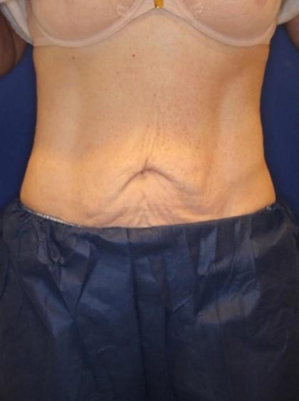 Emsculpt NEO Before & After Patient #14258