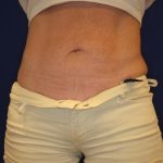 Emsculpt NEO Before & After Patient #14258