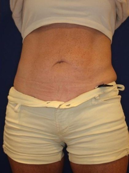 Emsculpt NEO Before & After Patient #14258