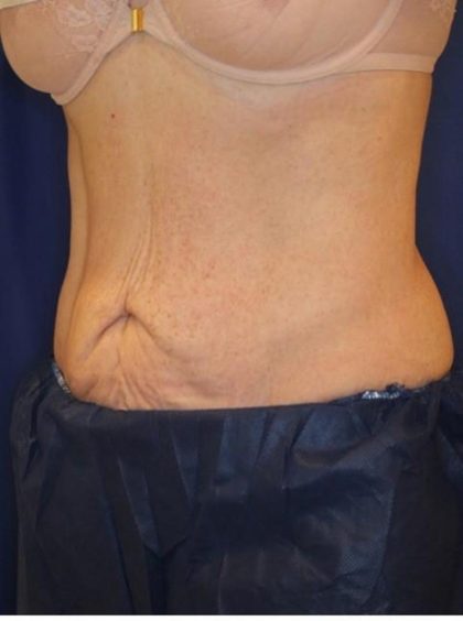 Emsculpt NEO Before & After Patient #14258
