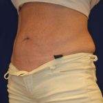 Emsculpt NEO Before & After Patient #14258