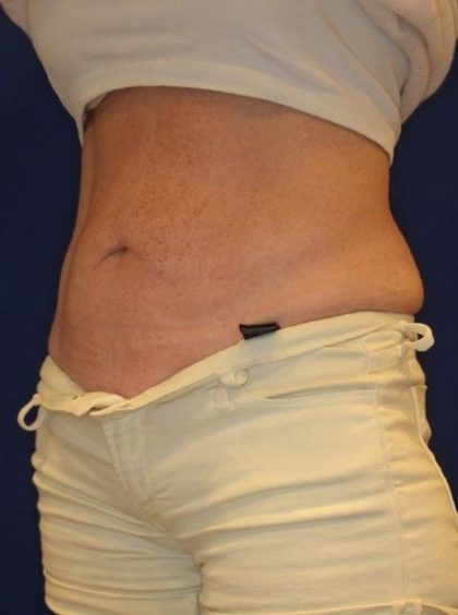 Emsculpt NEO Before & After Patient #14258