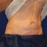 Emsculpt NEO Before & After Patient #14258