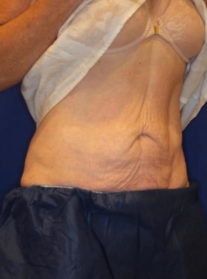 Emsculpt NEO Before & After Patient #14258