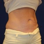 Emsculpt NEO Before & After Patient #14258