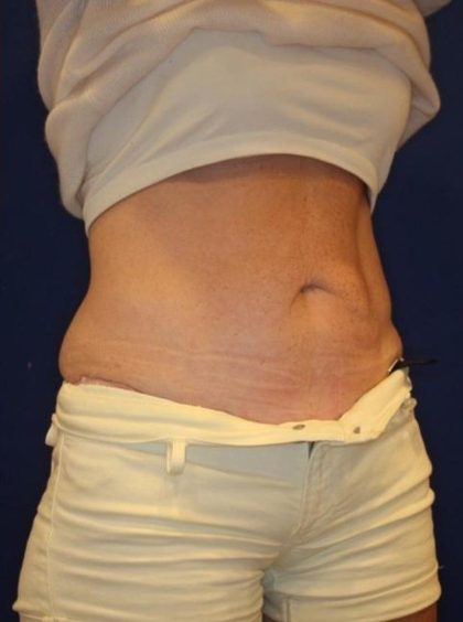 Emsculpt NEO Before & After Patient #14258