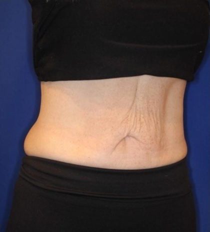 Emsculpt NEO Before & After Patient #14258