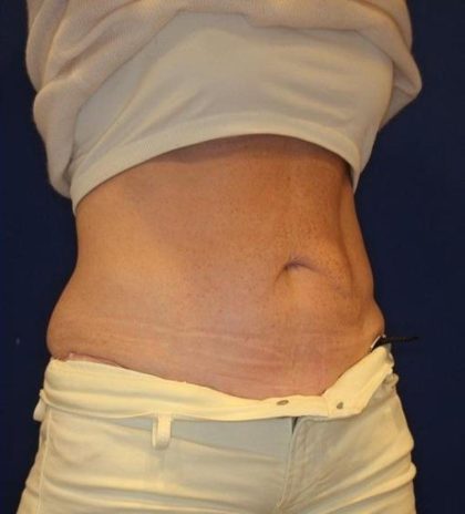 Emsculpt NEO Before & After Patient #14258