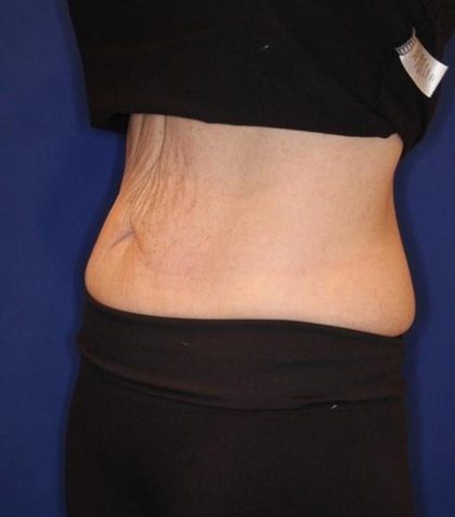 Emsculpt NEO Before & After Patient #14258