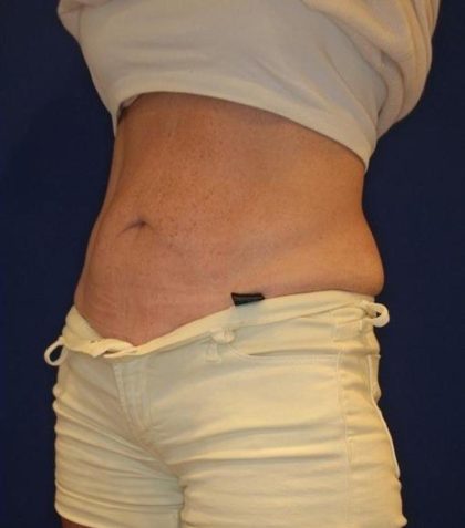 Emsculpt NEO Before & After Patient #14258