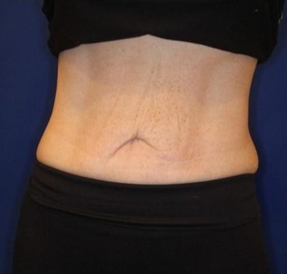 Emsculpt NEO Before & After Patient #14258