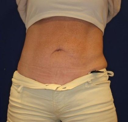 Emsculpt NEO Before & After Patient #14258