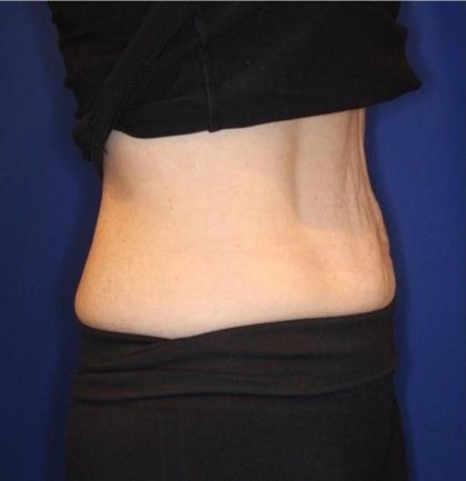 Emsculpt NEO Before & After Patient #14258