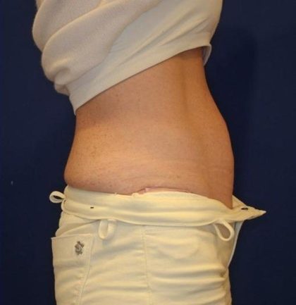 Emsculpt NEO Before & After Patient #14258