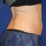 Emsculpt NEO Before & After Patient #14260