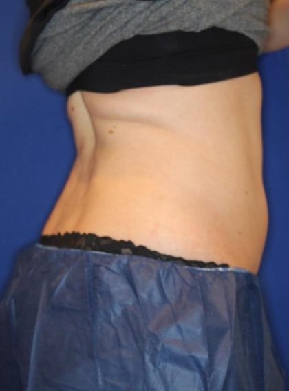 Emsculpt NEO Before & After Patient #14260