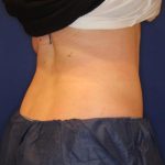 Emsculpt NEO Before & After Patient #14260